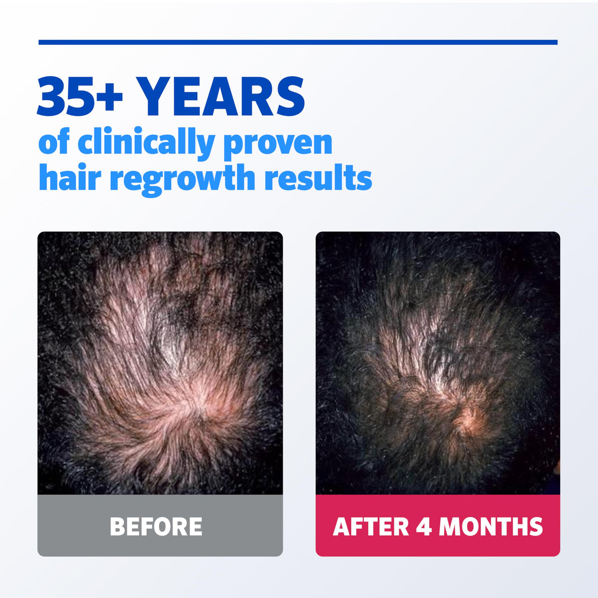 Men hair regrowth treatment active ingredient label information