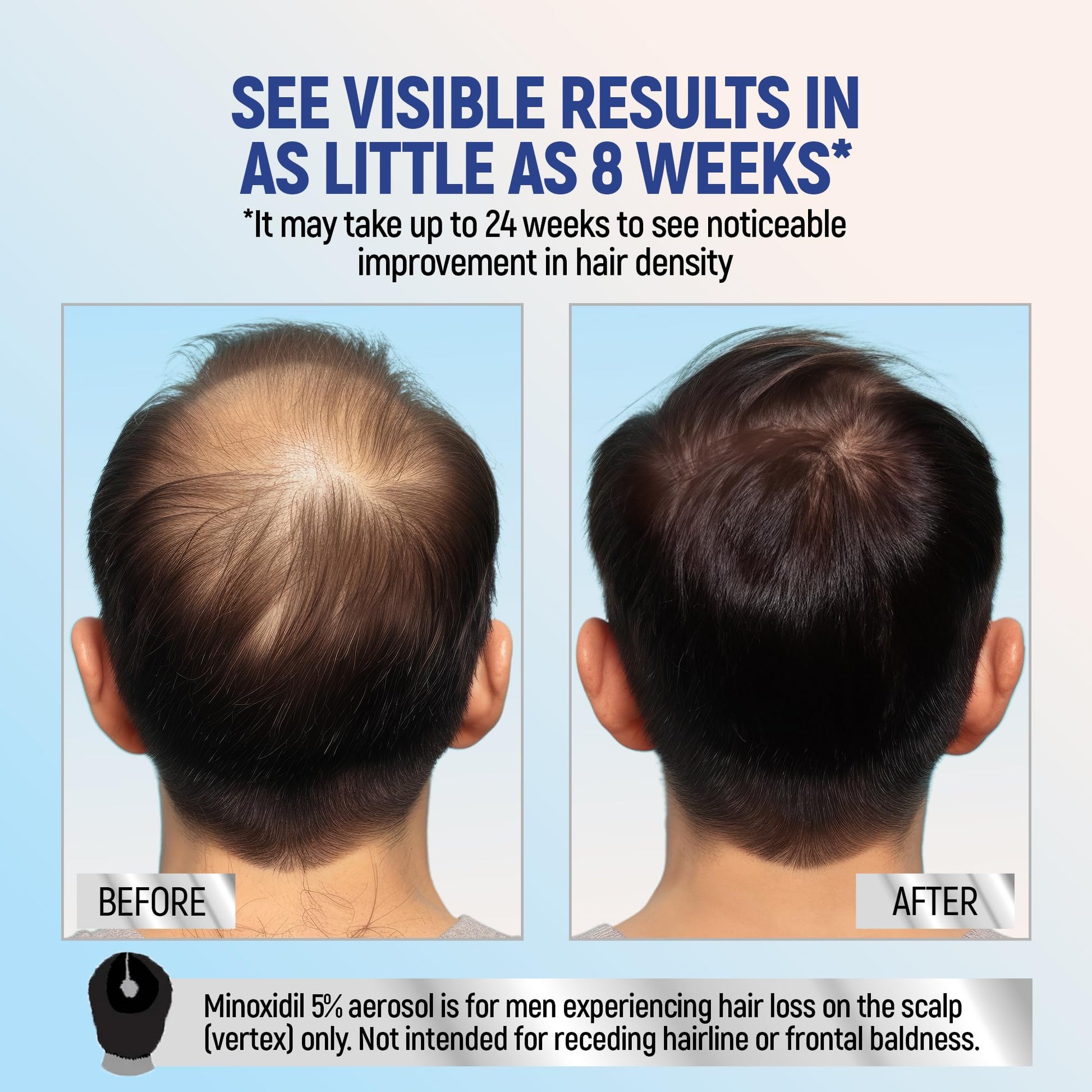 Four month supply of Taro minoxidil topical foam for male pattern thinning hair solutions