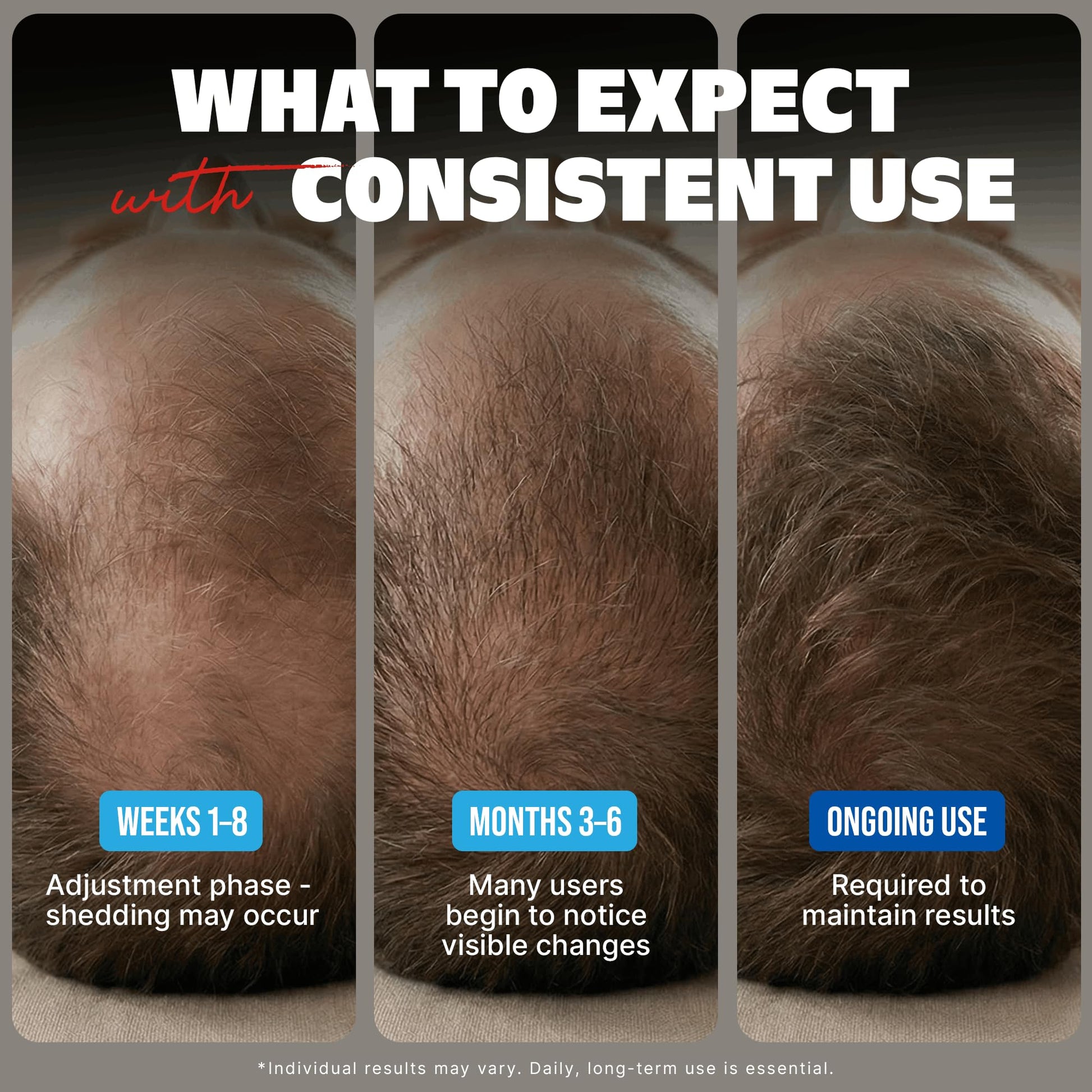Five percent minoxidil topical solution for male pattern baldness and thinning hair