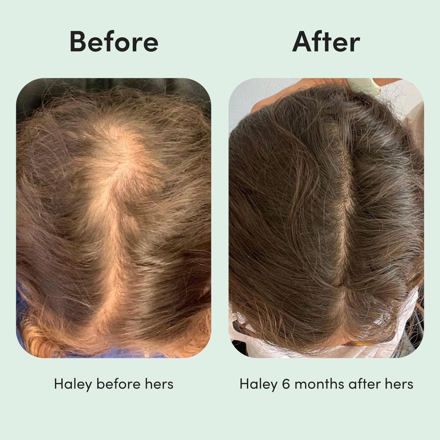 Hers hair care product package items unboxed for female pattern baldness care.