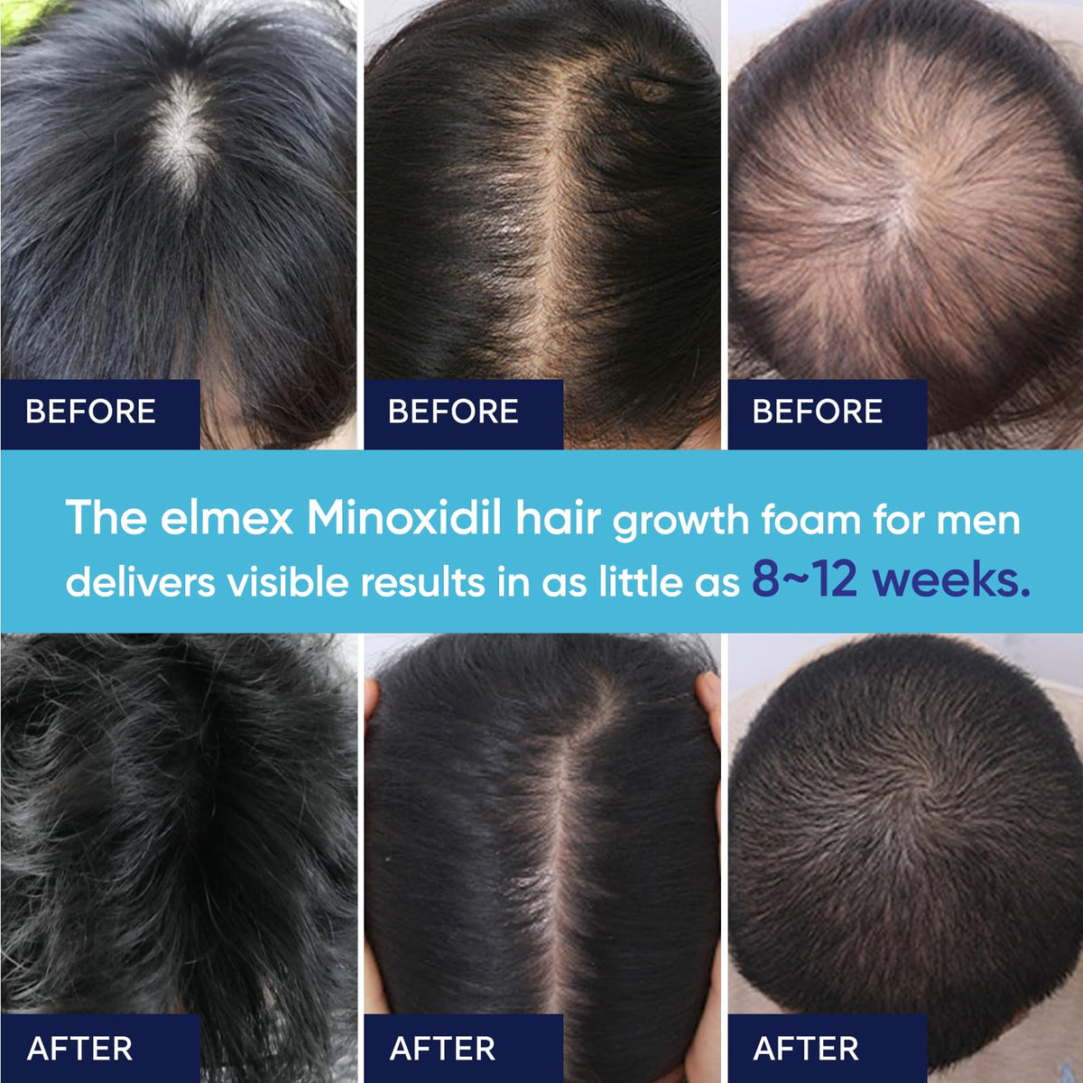 Artimore unscented minoxidil foam daily usage demonstration