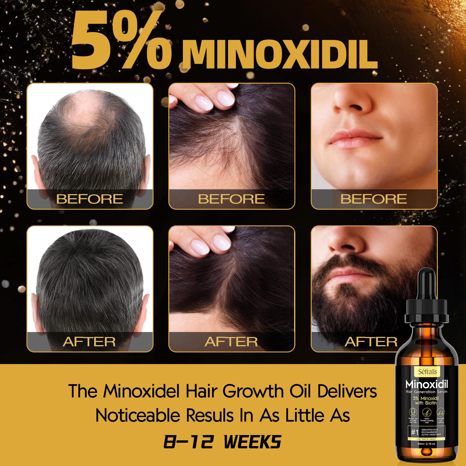 Stafenit 5 percent minoxidil dropper bottle showing application instructions on the label