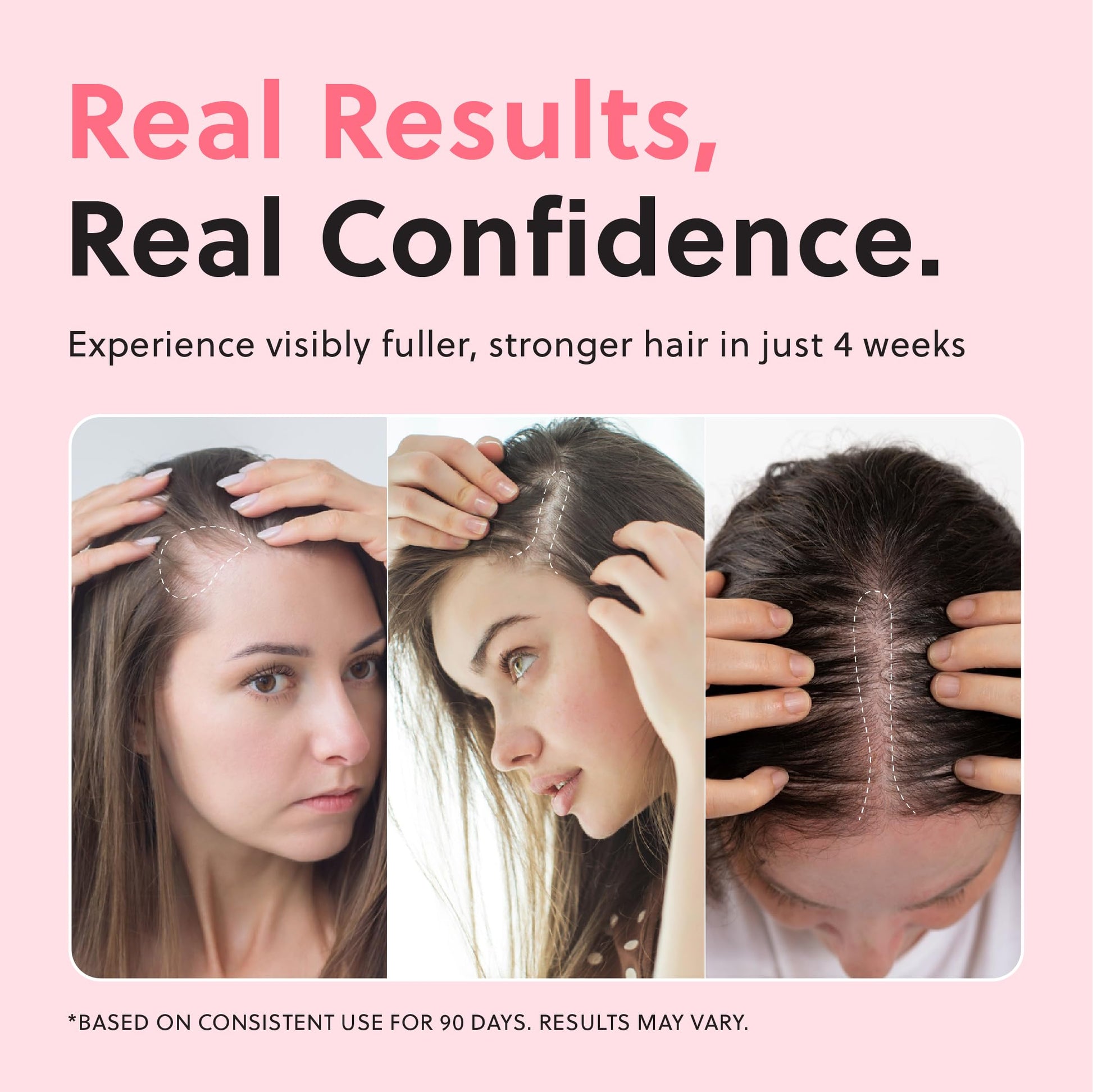 ForChics non greasy scalp spray packaging showing official brand labeling and benefits