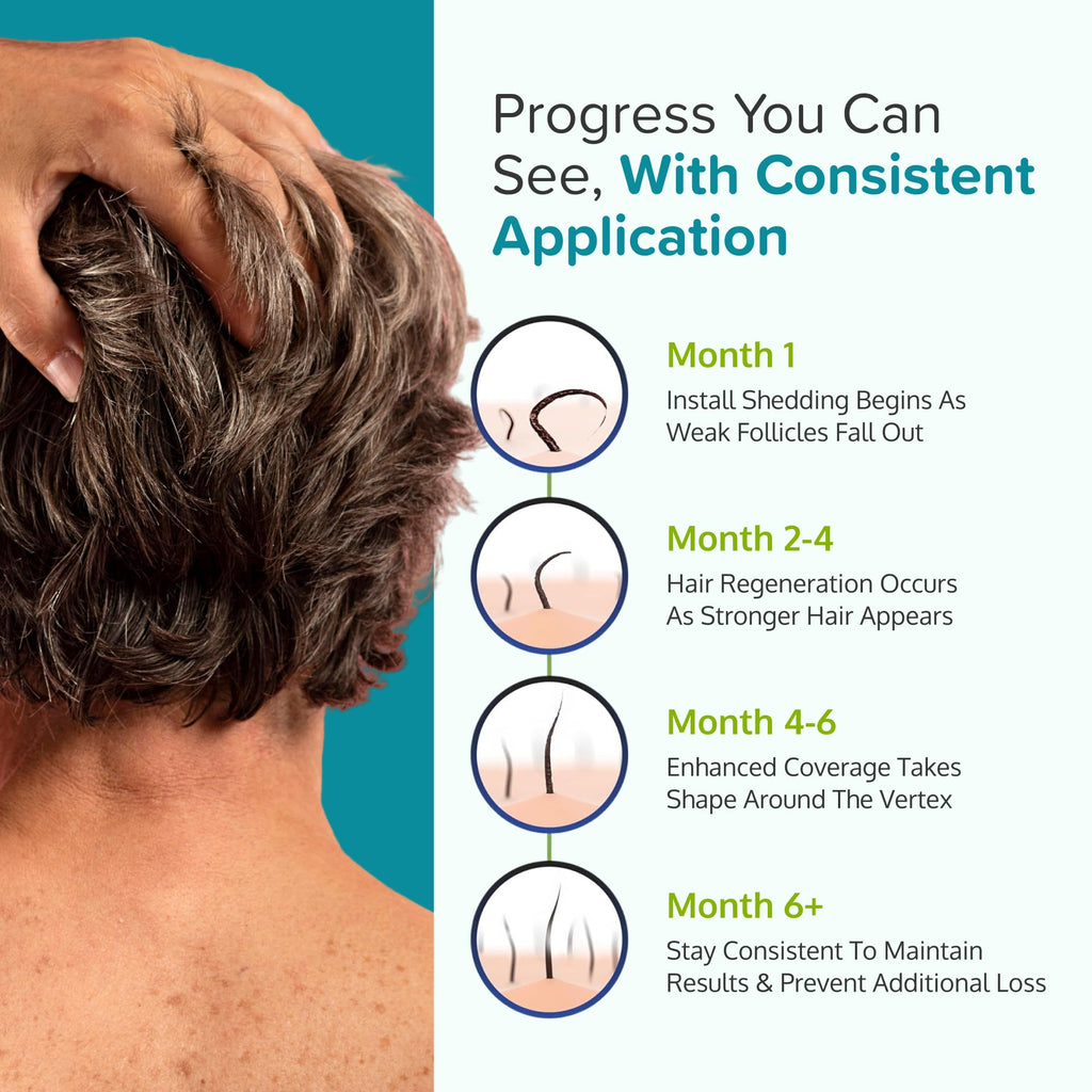 C'rcle Regoxidine vertex hair loss treatment complete set