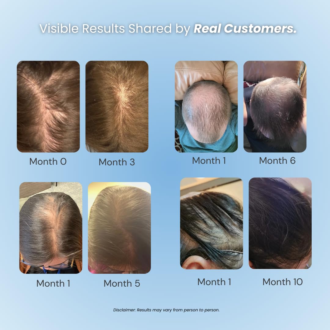 Growplex Vitafoam 5 percent minoxidil container showing product features