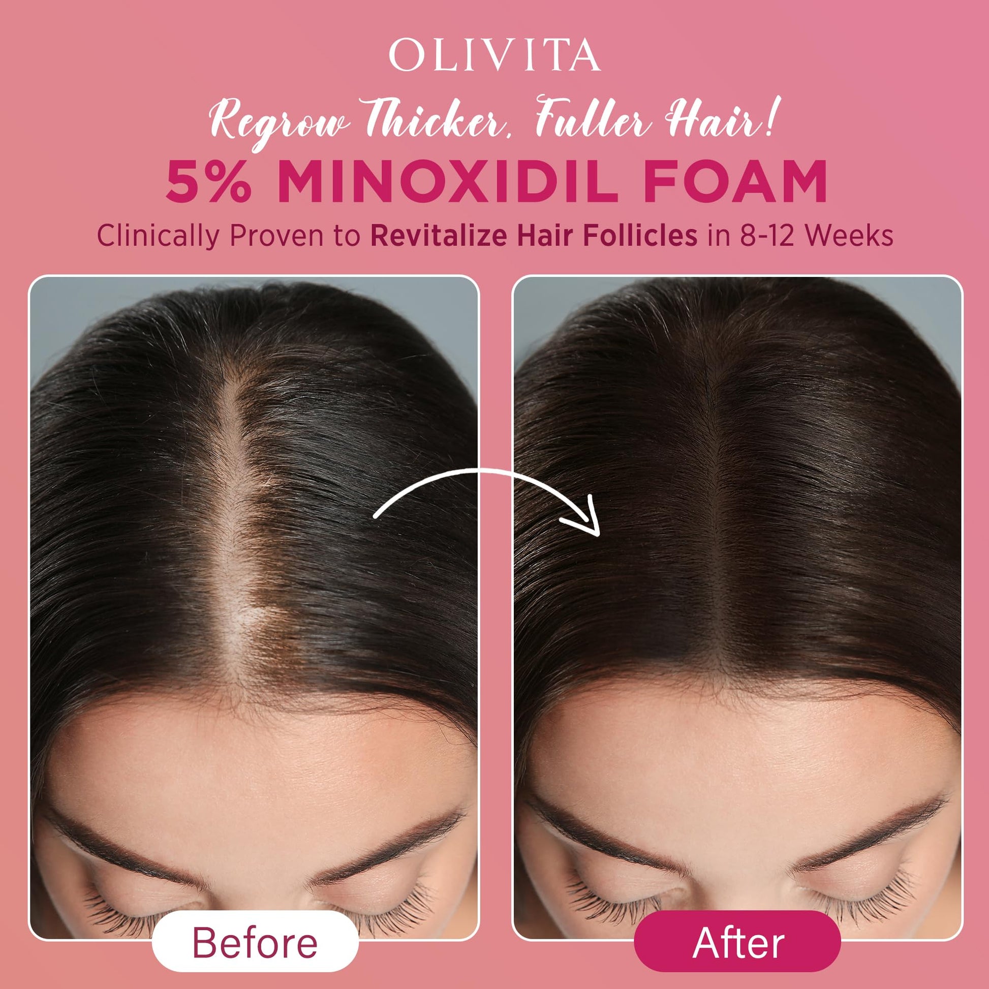 Close up of five percent minoxidil foam container showing directions for once daily application