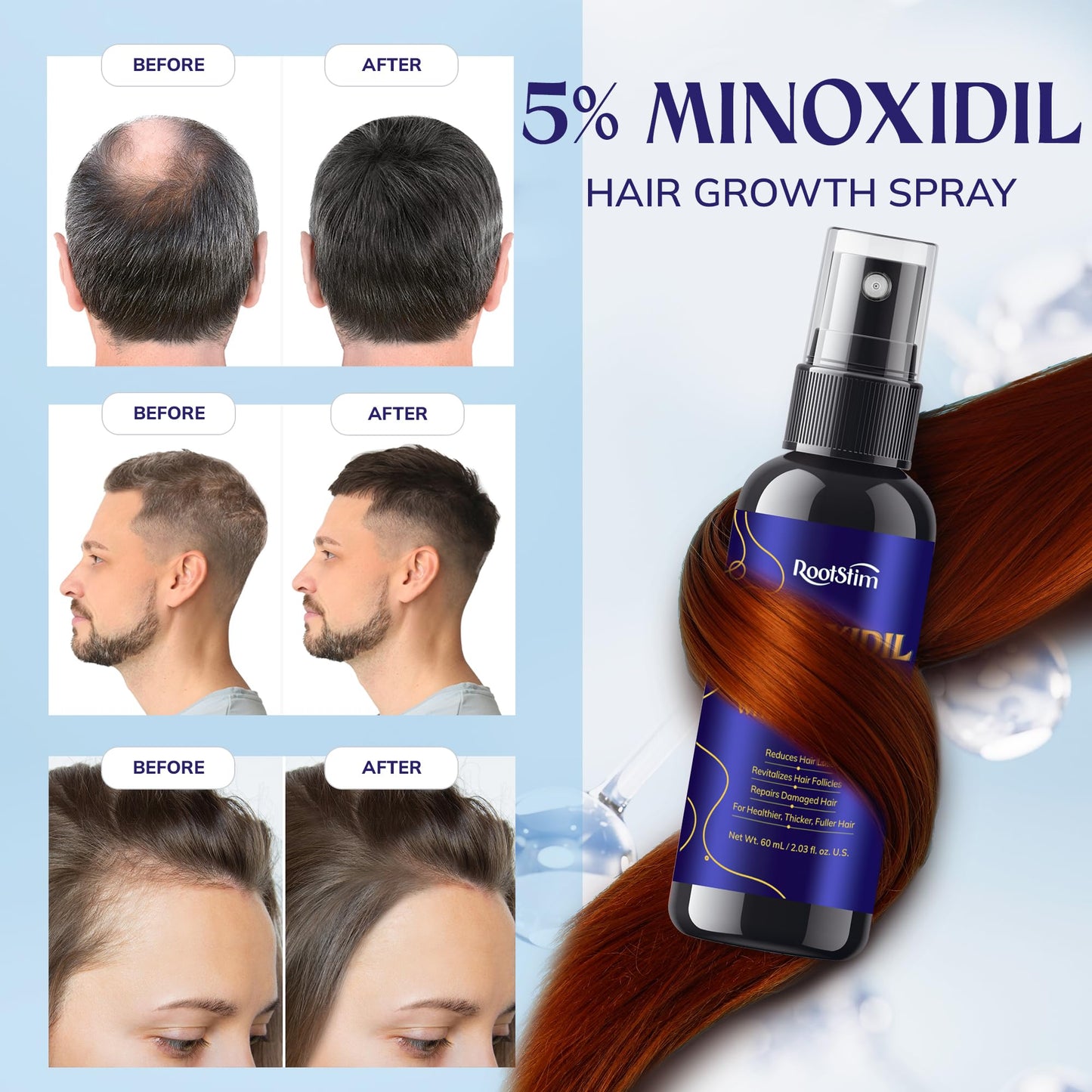 RootStim minoxidil 5 percent topical spray nozzle design