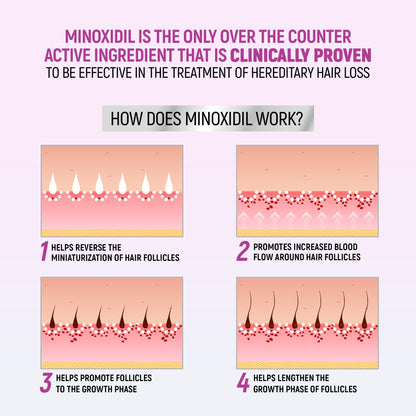 Imported USA Taro minoxidil foam for female hereditary hair loss
