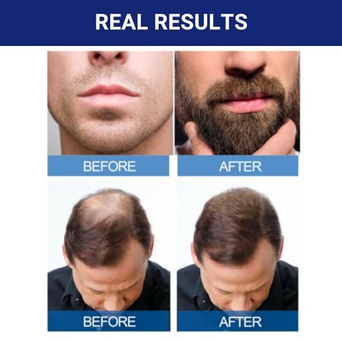 Kirkland Signature unscented minoxidil topical solution dropper applicator close up