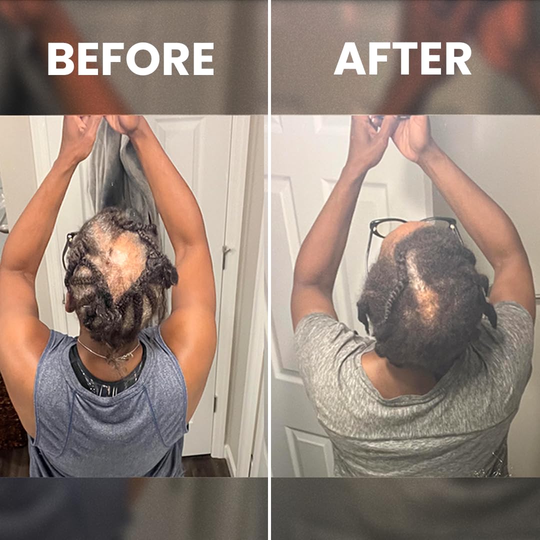 Rennora Beauty intensive hair regrowth solution showing the fluid ounce size and botanical product label.