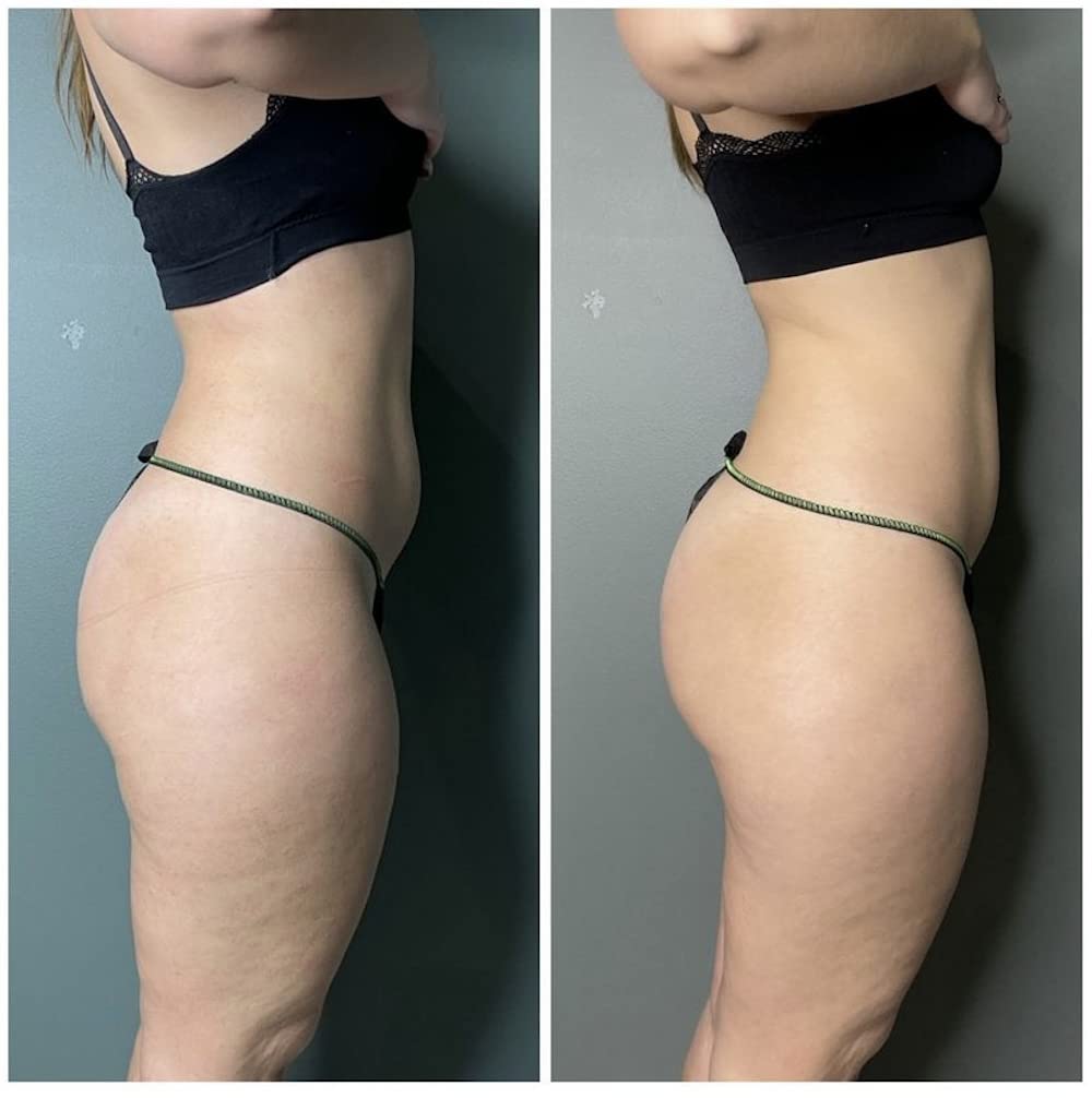 Top angle view of the 1 Kilogram professional pack of Guam anti-cellulite legs and thighs mask.