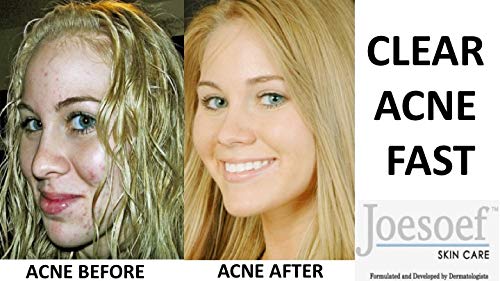 Joesoef Skin Care soap for acne and rosacea care