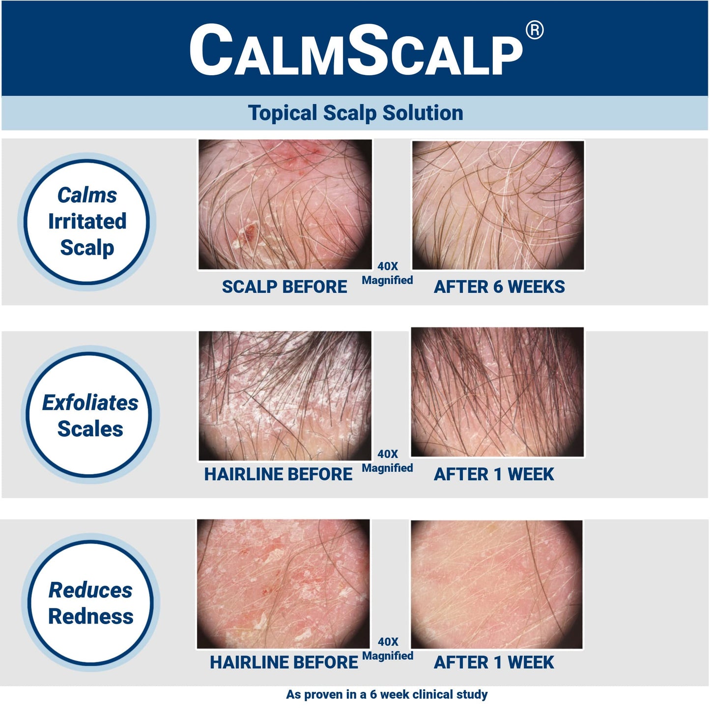 CalmScalp scalp solution bottle with applicator tip
