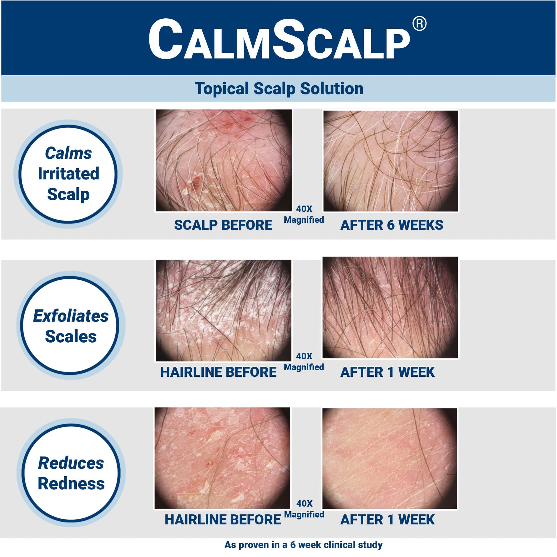 CalmScalp scalp solution bottle with applicator tip