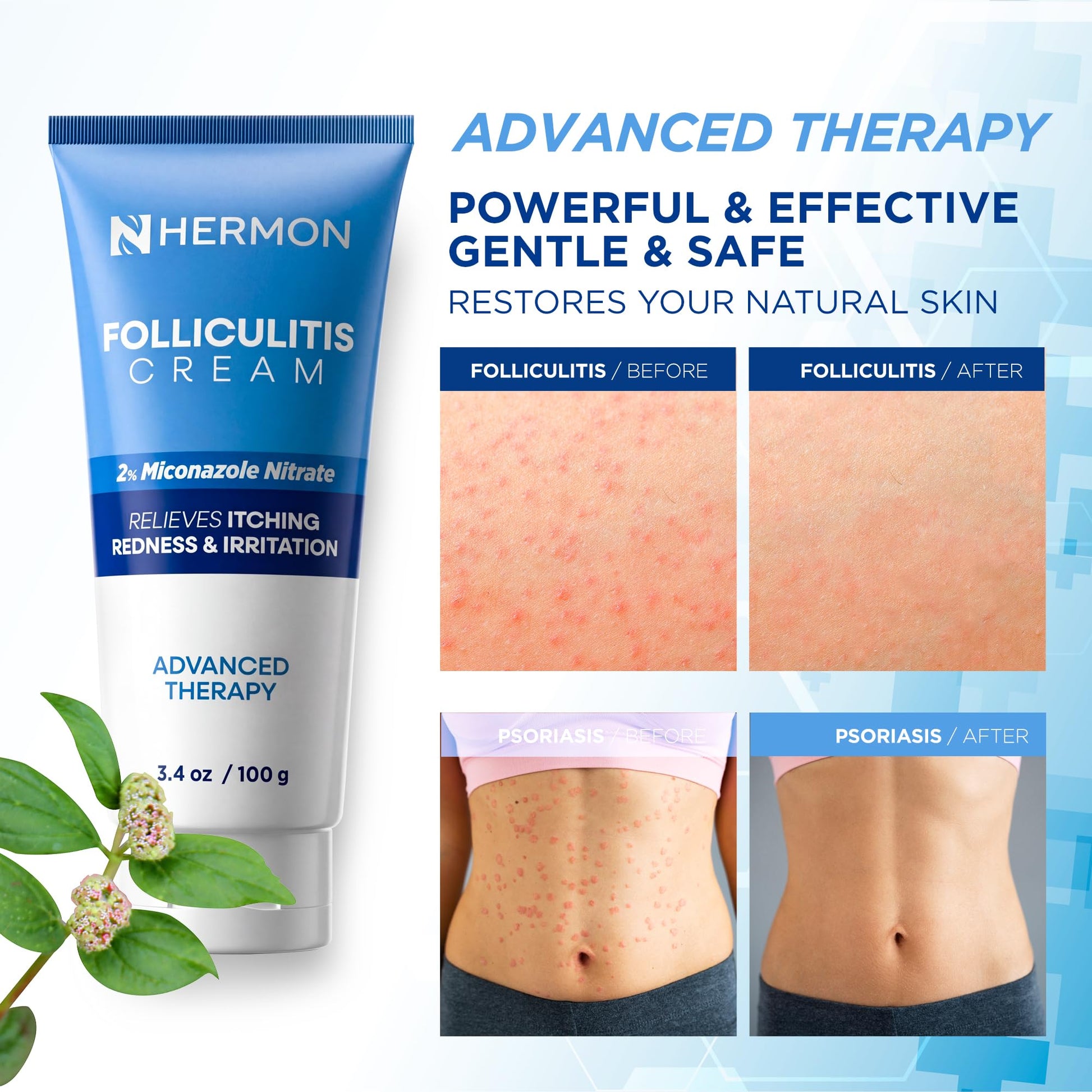 Side view of Hermon Folliculitis Cream packaging