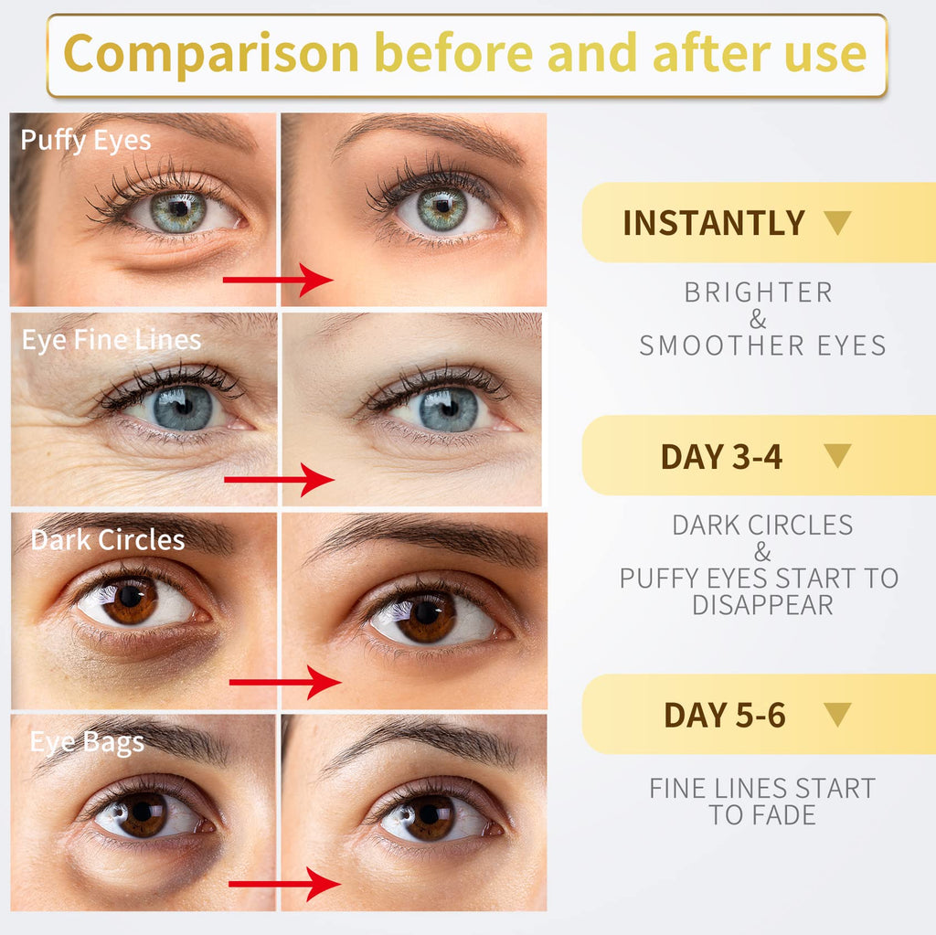 Model applying gold hydrogel eye patch for under eye dark circles and puffiness