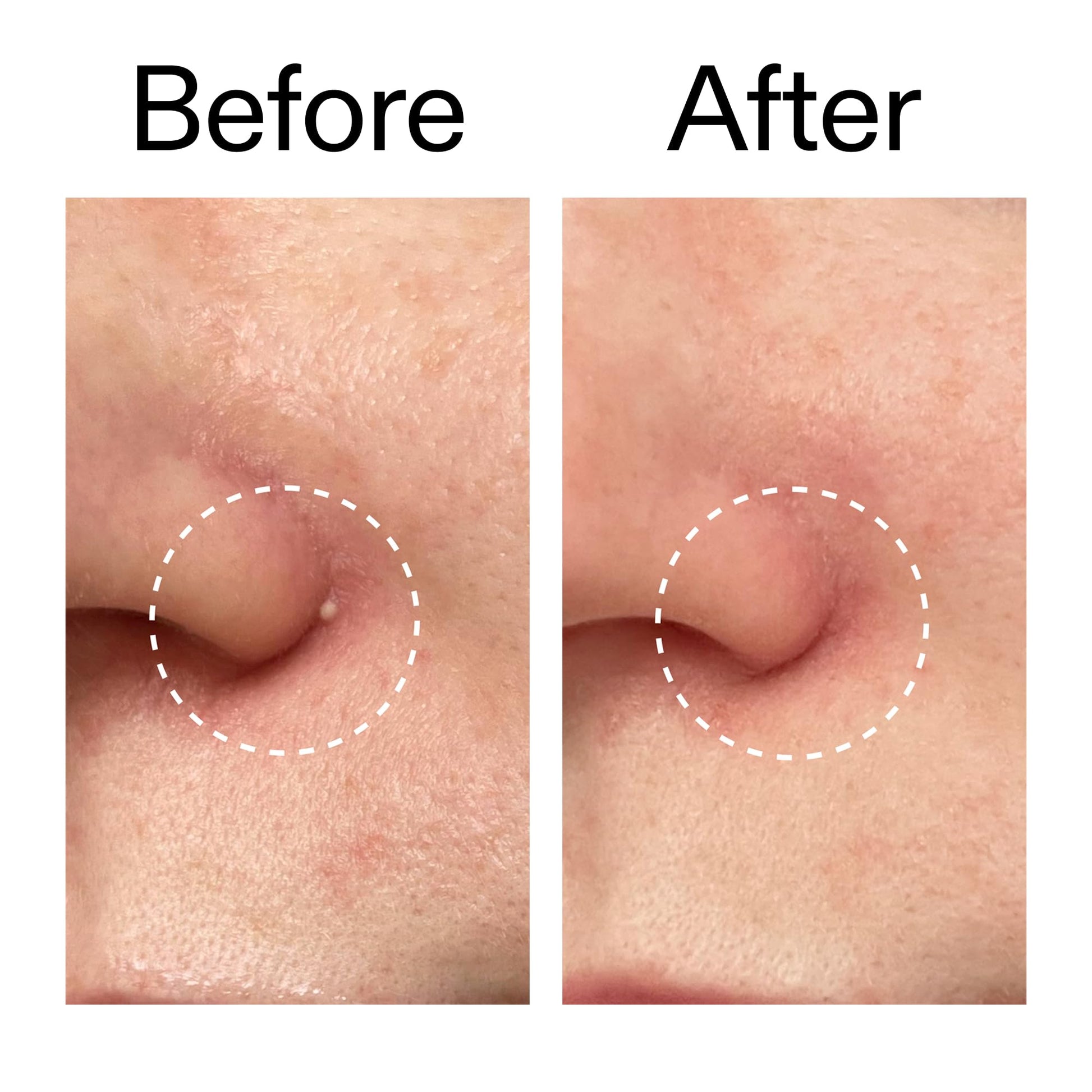 The INKEY List anti acne hydrocolloid patches demonstration of thin seamless texture