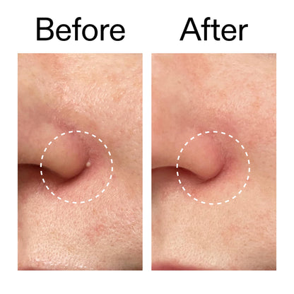 The INKEY List anti acne hydrocolloid patches demonstration of thin seamless texture