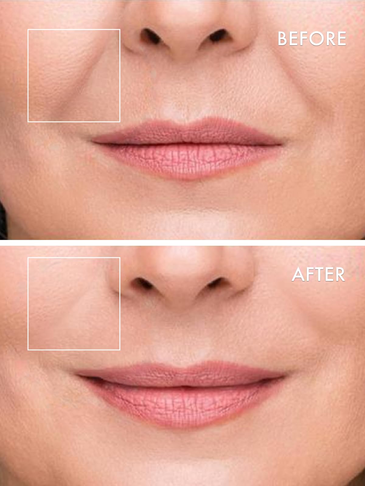 Before and after visualization of under eye wrinkles utilizing Depology deepcare micro dart treatment