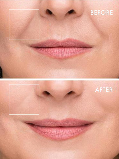 Before and after visualization of under eye wrinkles utilizing Depology deepcare micro dart treatment