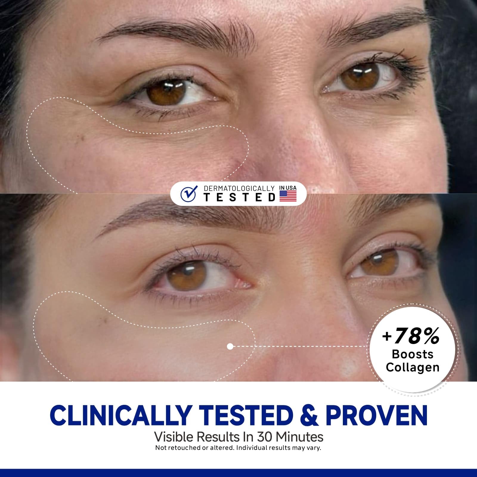 Dr Vincent hydrogel eye mask patches applied under the eyes for dark circles treatment.