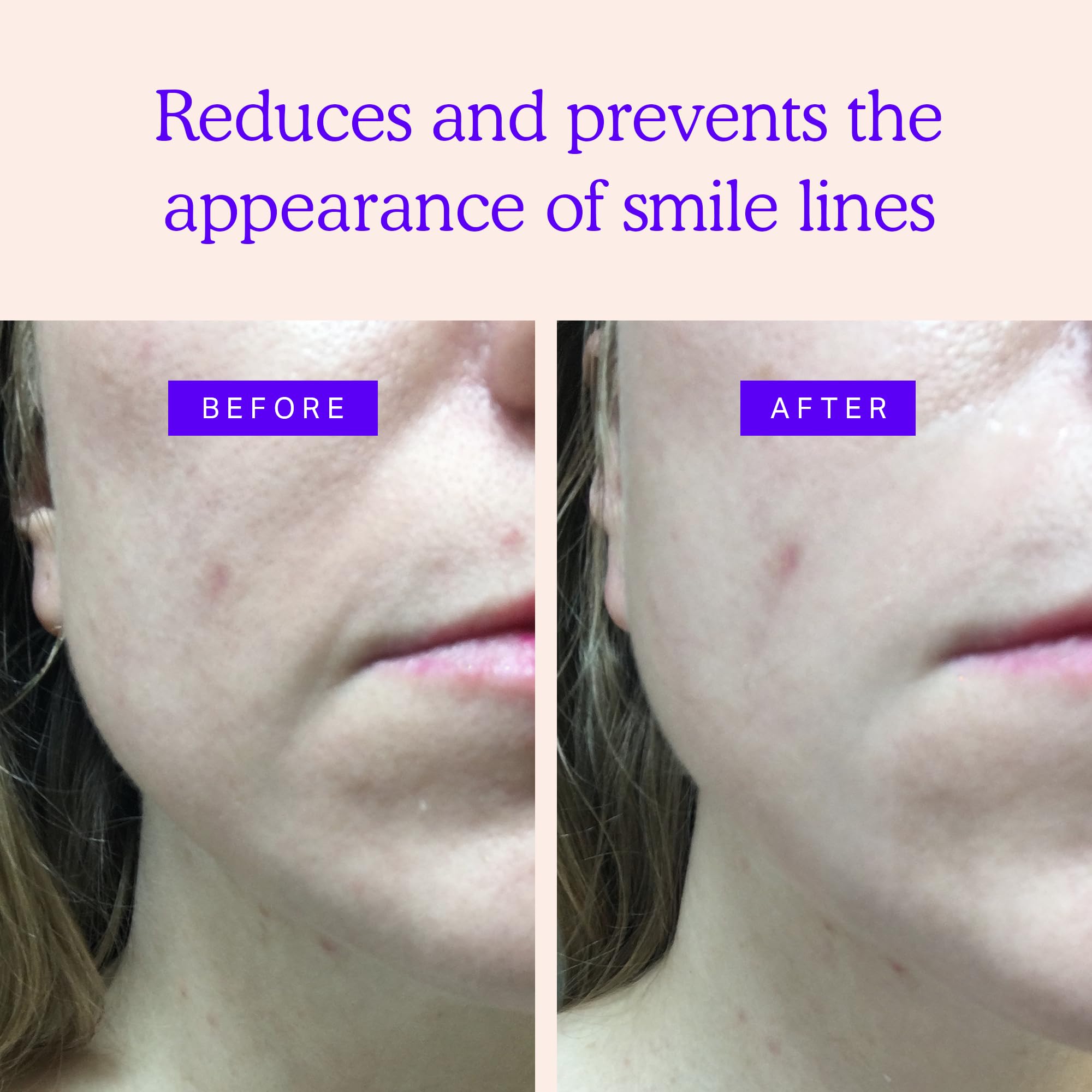 BLUMBODY non silicone face patches applied around the mouth to smooth laugh lines