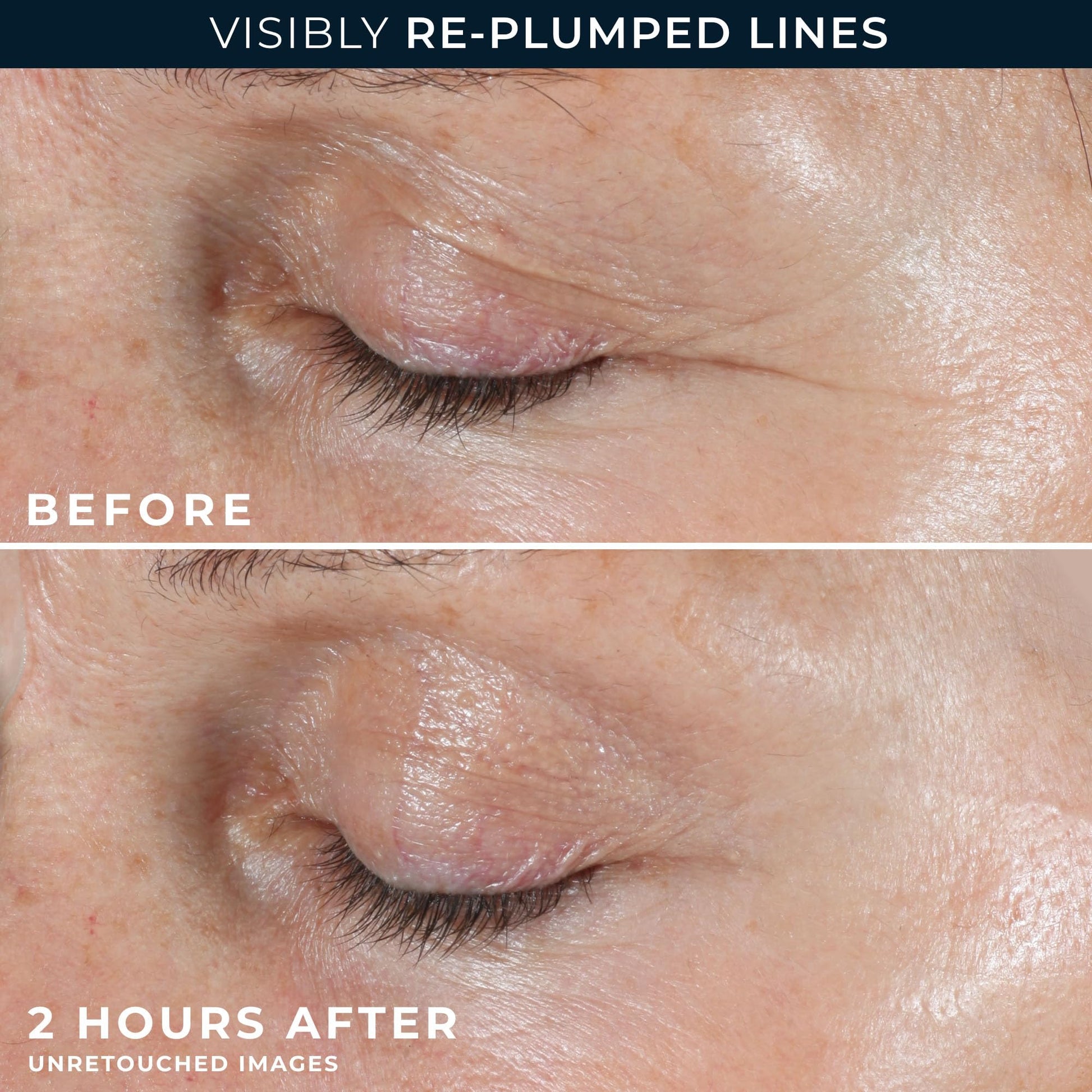 Skincare application model showing correct placement of RoC retinol patches on laugh lines and eleven lines.