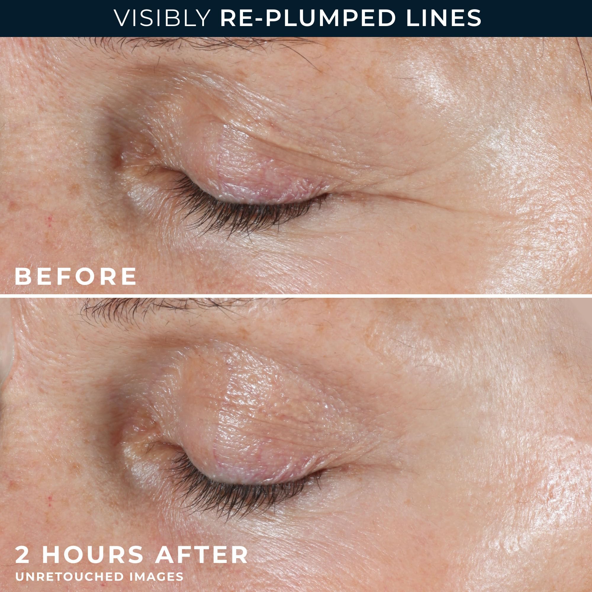 Skincare application model showing correct placement of RoC retinol patches on laugh lines and eleven lines.