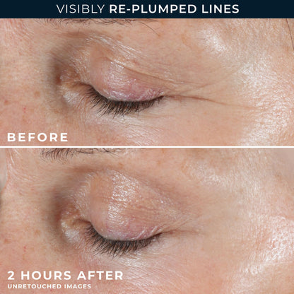 Skincare application model showing correct placement of RoC retinol patches on laugh lines and eleven lines.