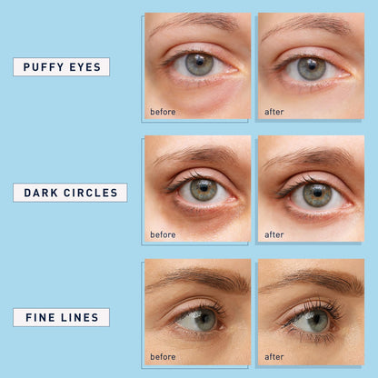 Under eye treatment pads application process on clean skin for wrinkles and puffiness