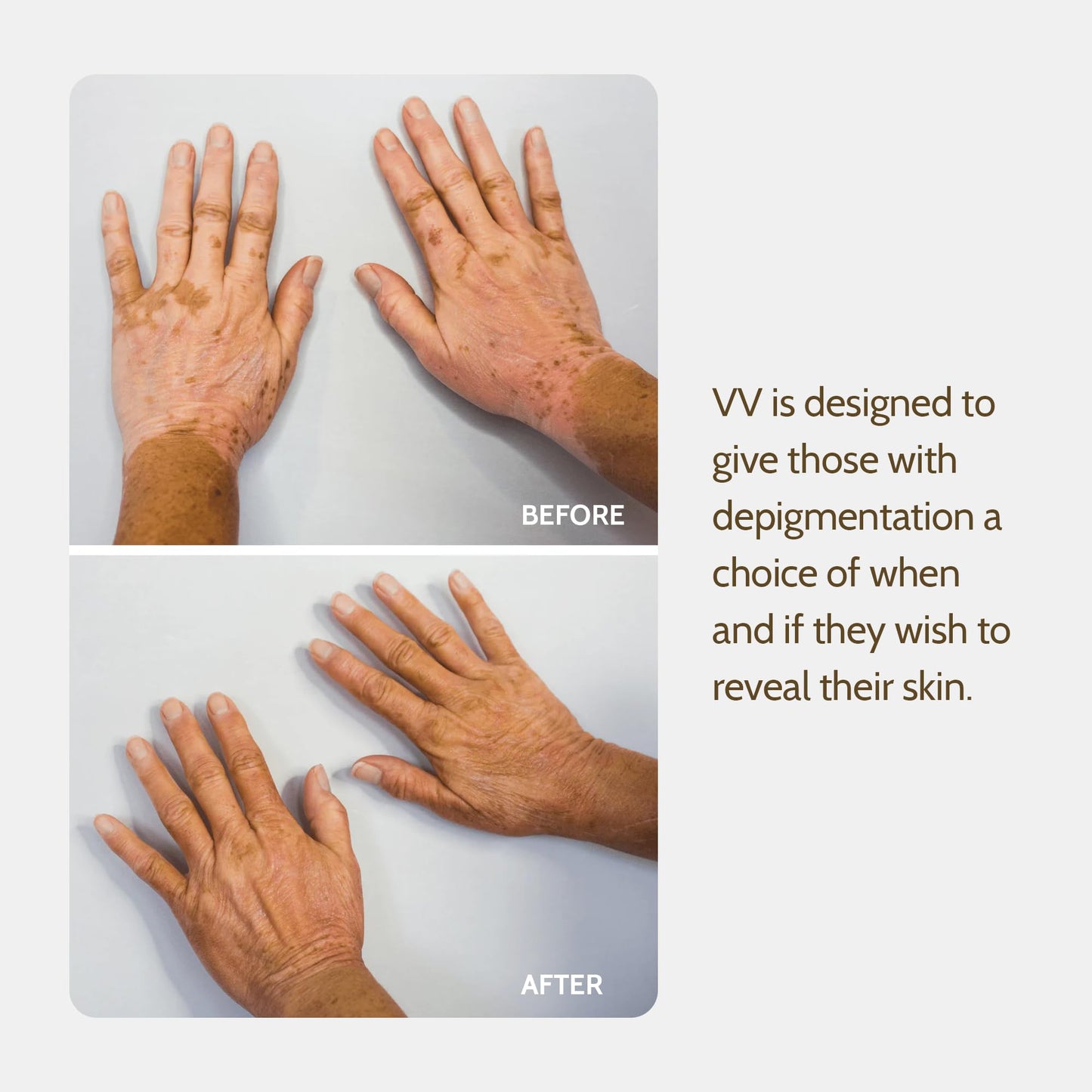 Application process for Vitiligo Vanquish camouflage