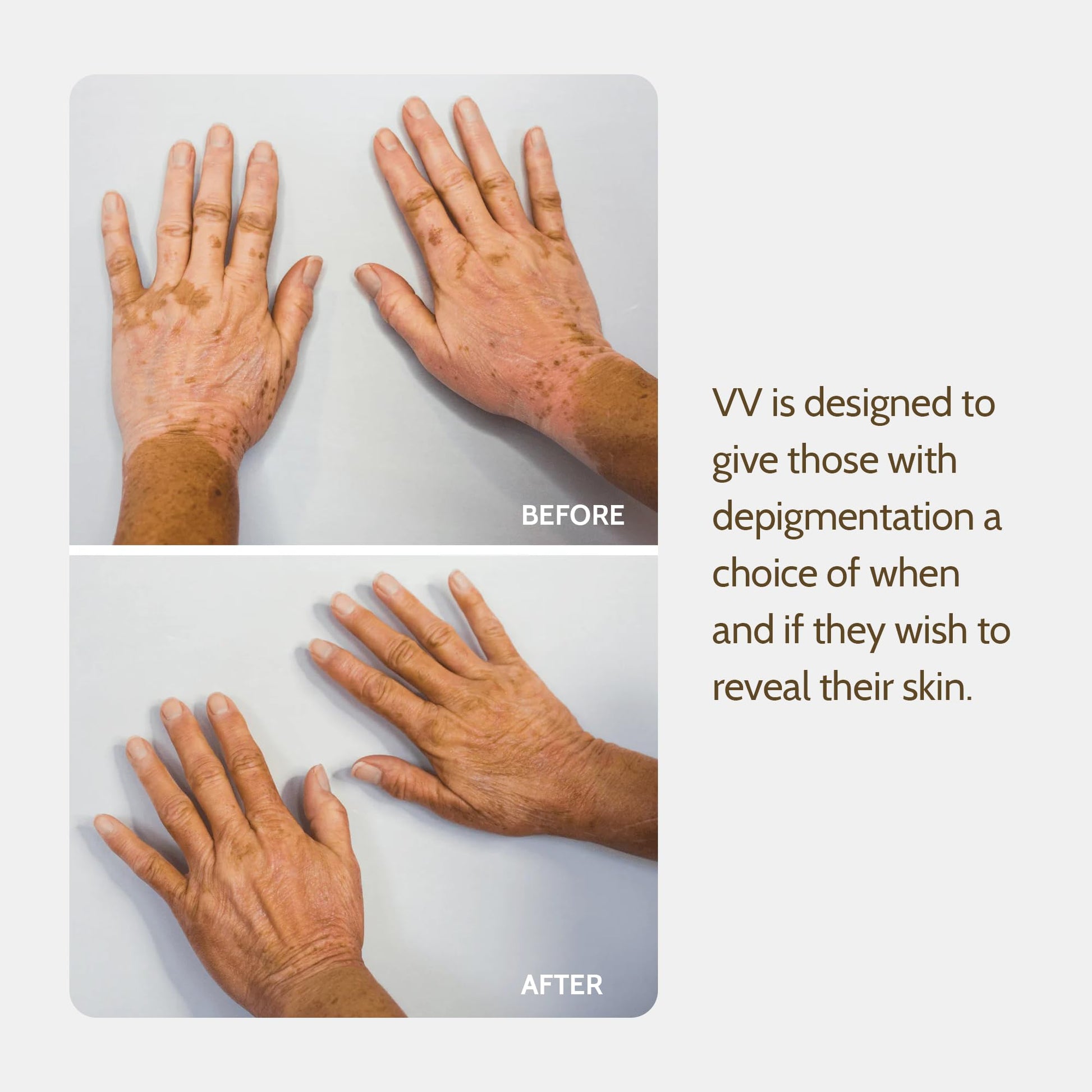 Application process for Vitiligo Vanquish camouflage