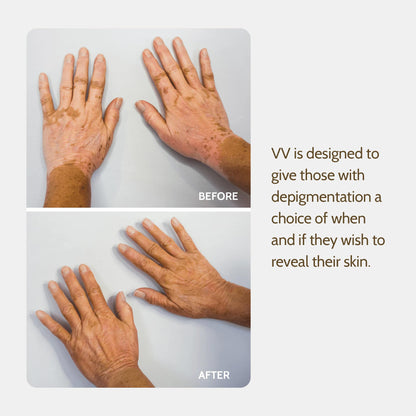 Application process for Vitiligo Vanquish camouflage
