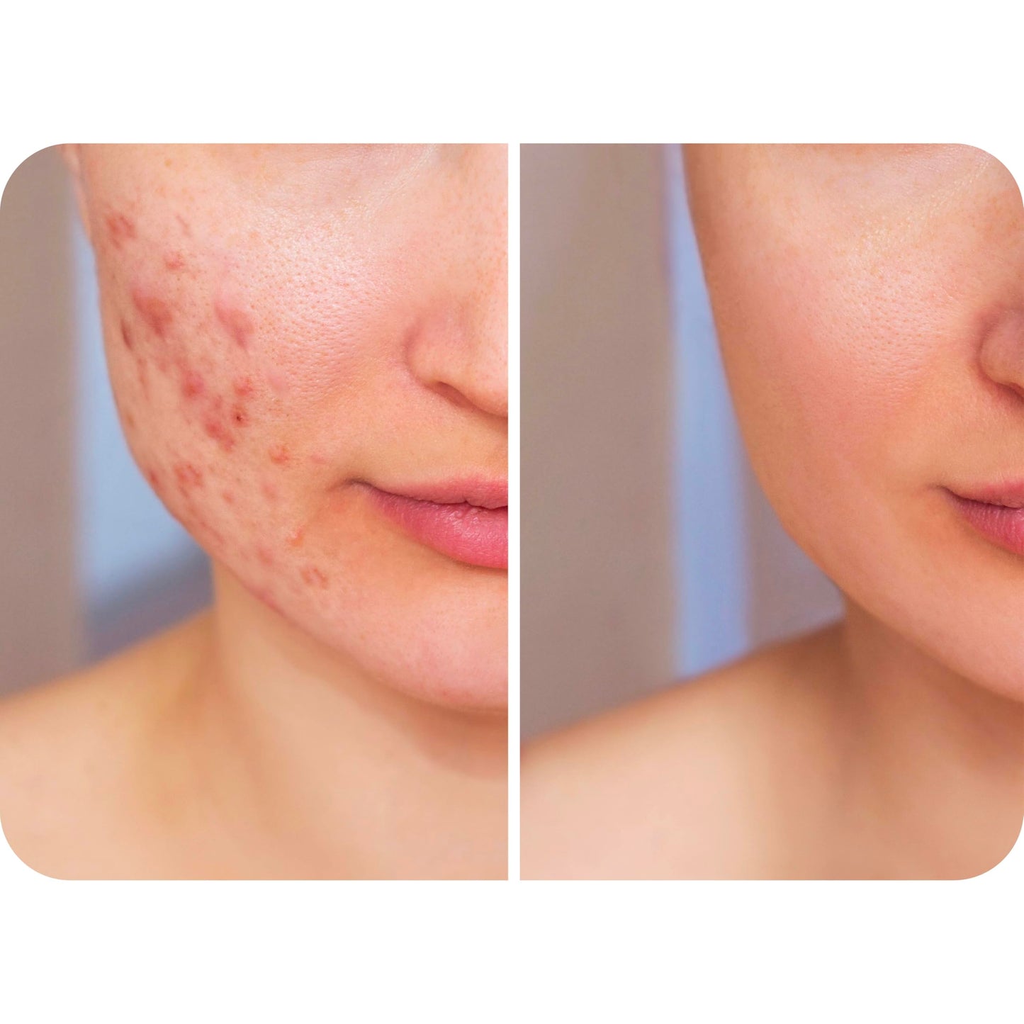 HypoClear HOCl spray for eyelid and sensitive skin care
