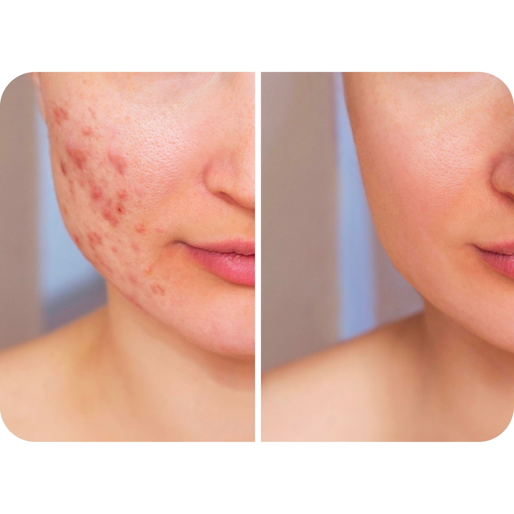 HypoClear HOCl spray for eyelid and sensitive skin care