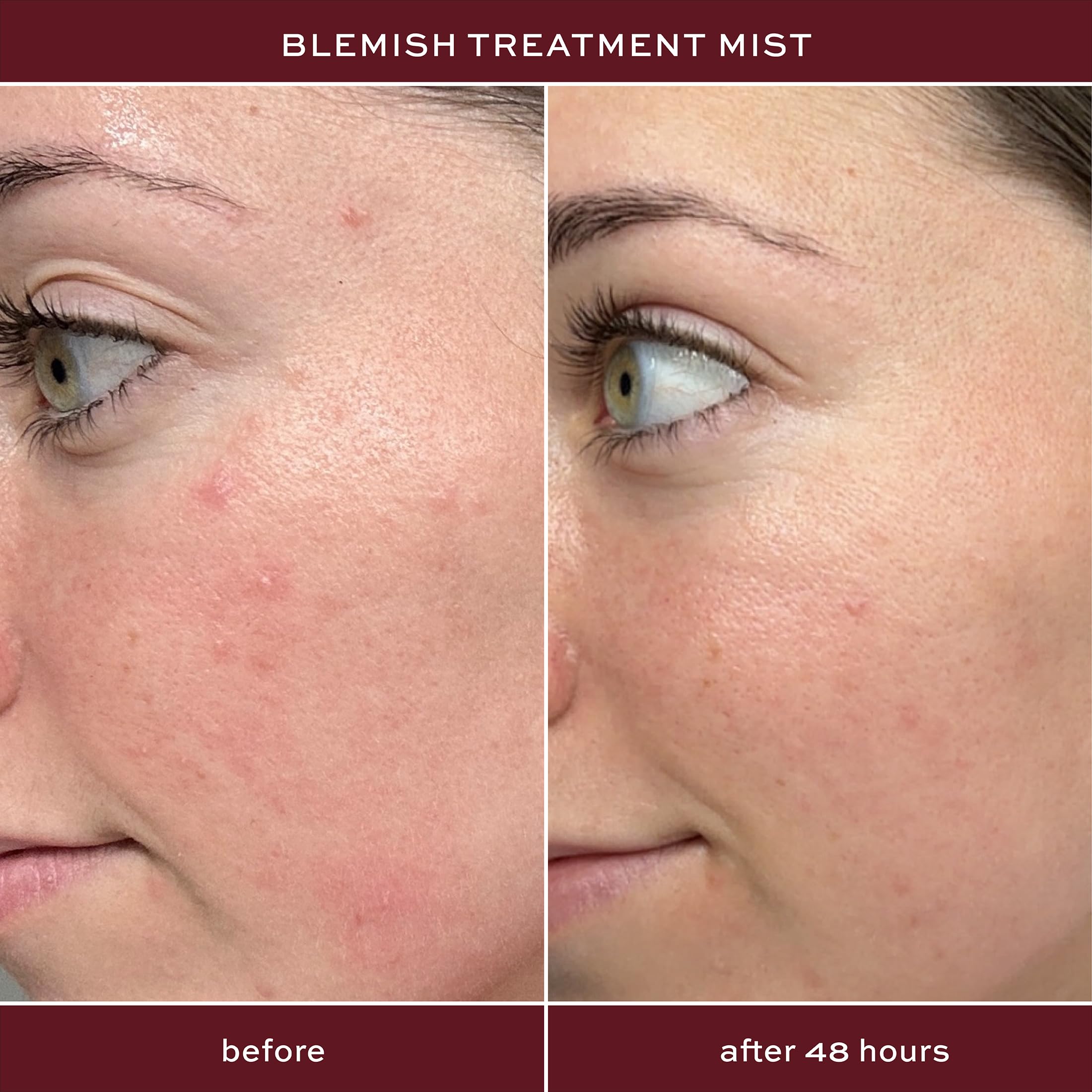 Close up of ITK blemish fighting mist nozzle for easy application