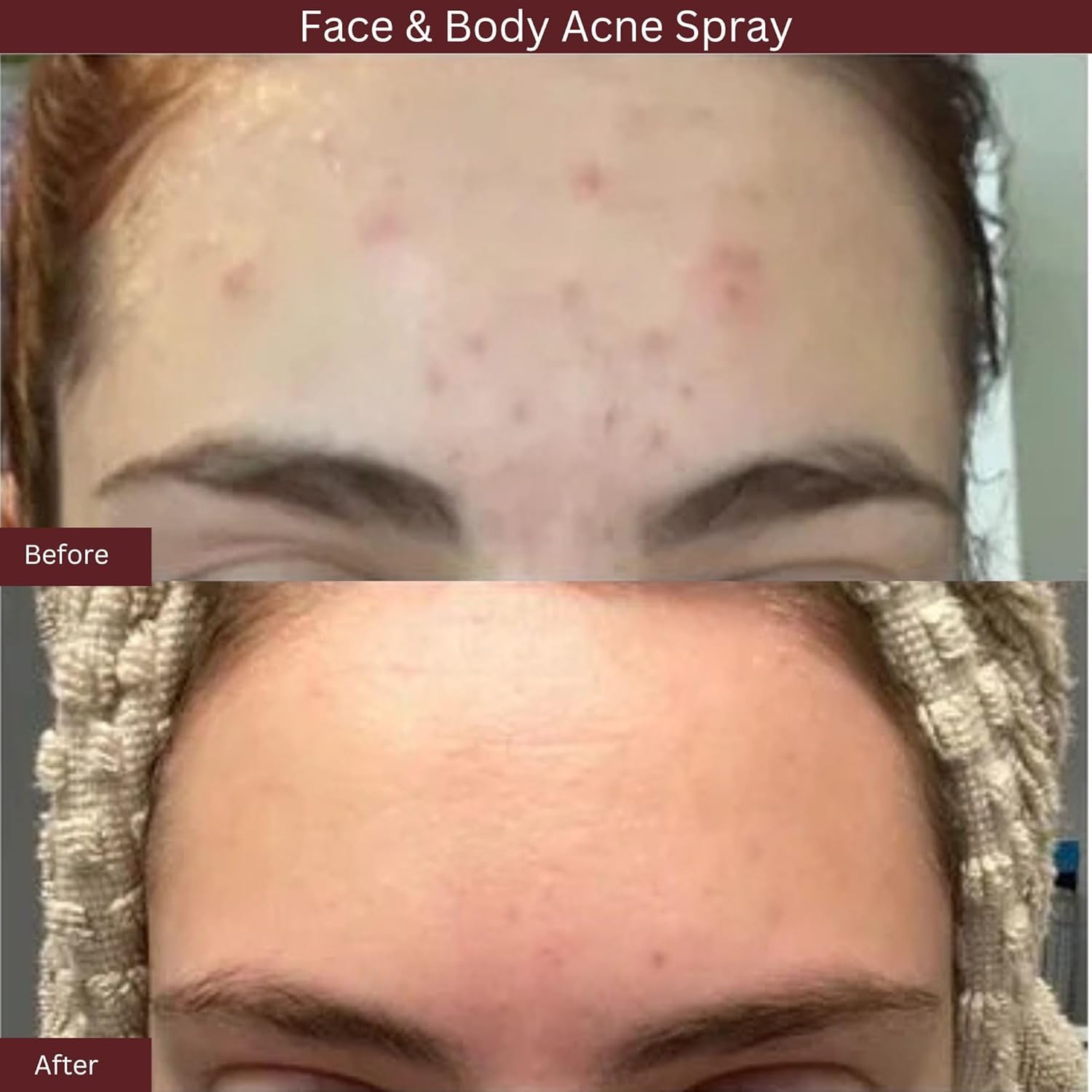 ITK skincare salicylic acid spray for back acne application