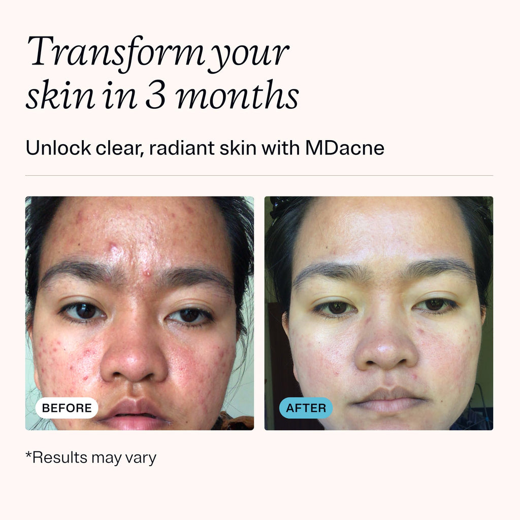 MDacne benzoyl peroxide treatment cream tube display