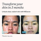 MDacne benzoyl peroxide treatment cream tube display