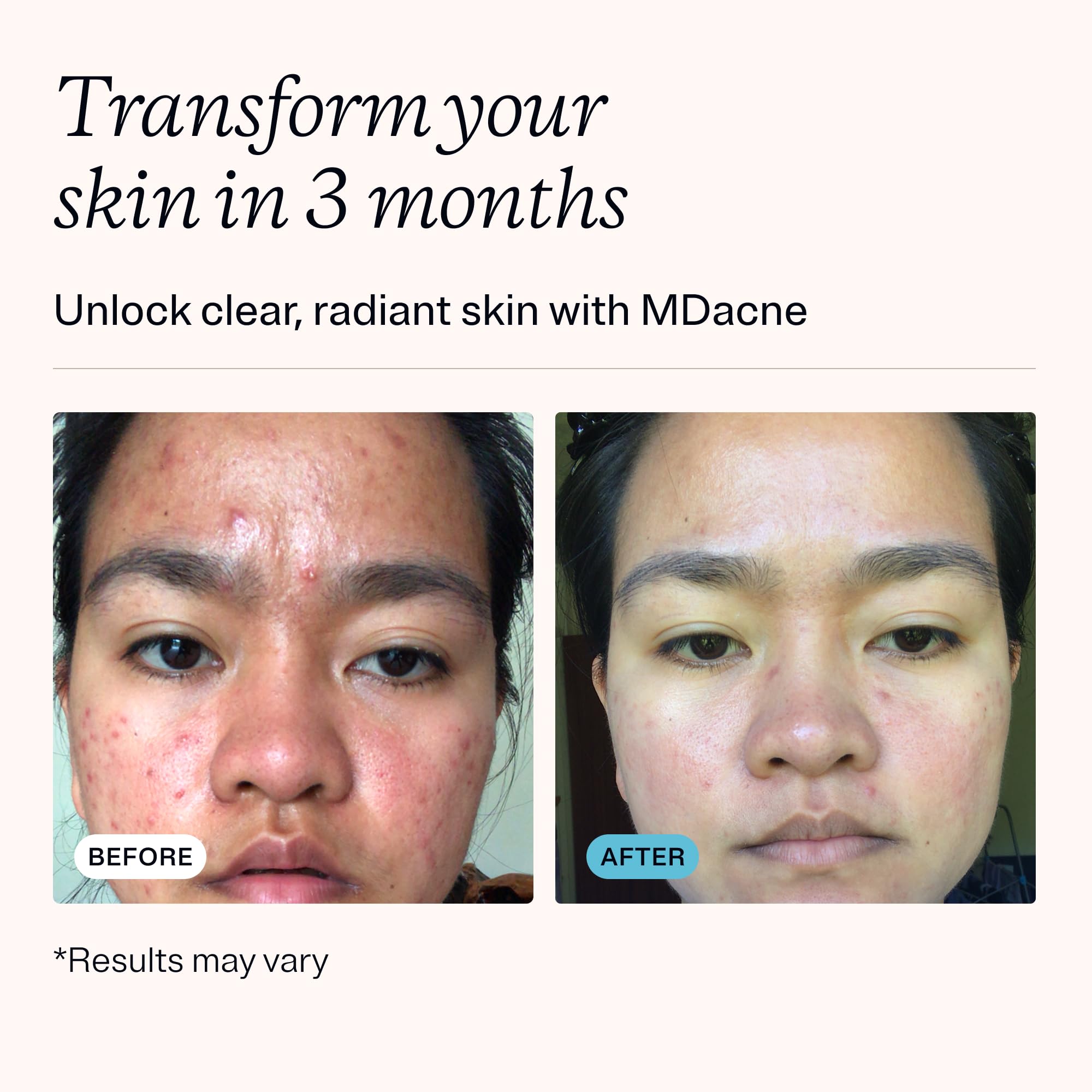MDacne Benzoyl Peroxide Cream tube for acne treatment
