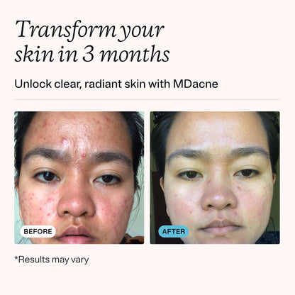 MDacne Benzoyl Peroxide Cream tube for acne treatment