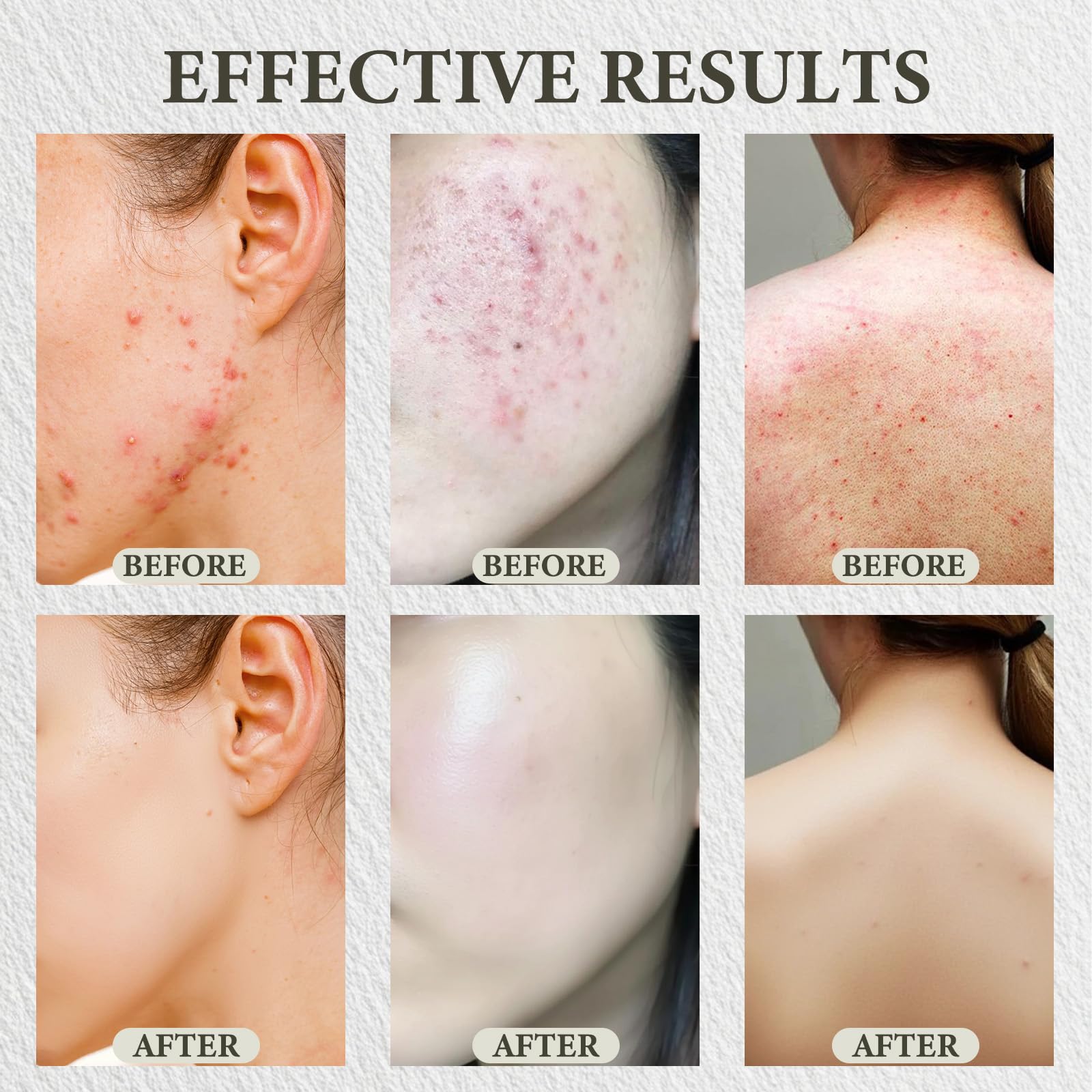 SDXJIOGE Scars Revive Balm formulated with plantain extract to fade post acne marks