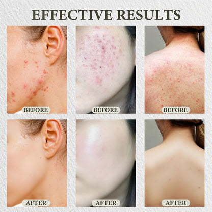 SDXJIOGE Scars Revive Balm formulated with plantain extract to fade post acne marks