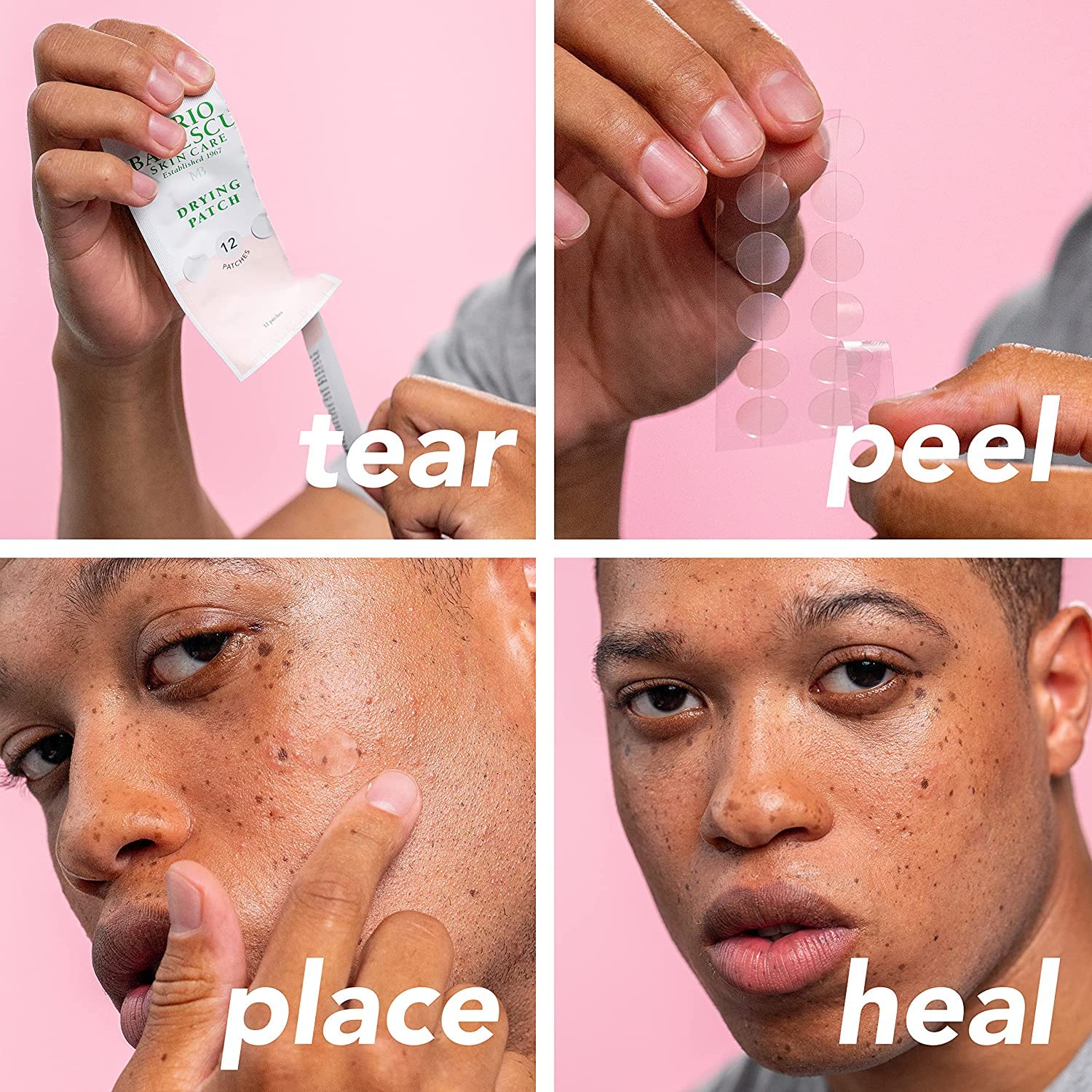 Mario Badescu blemish kit unboxing view showcasing the one fluid ounce bottle and twelve adhesive patches.