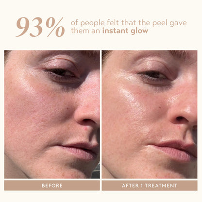 The complete Shani Darden two step resurfacing kit packaging including the exfoliating acids.