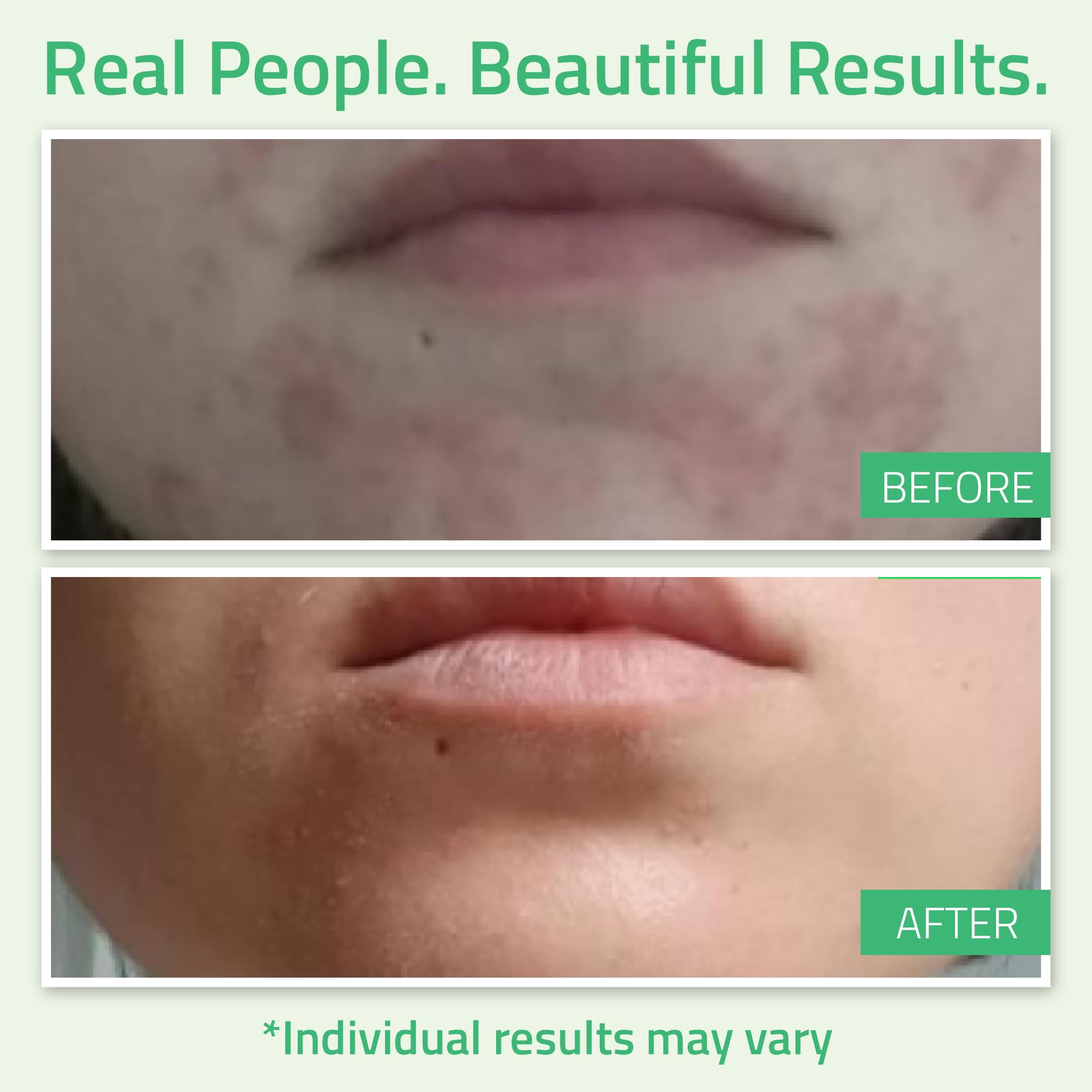 YEOUTH anti aging facial peel treatment for reducing wrinkles and acne scars