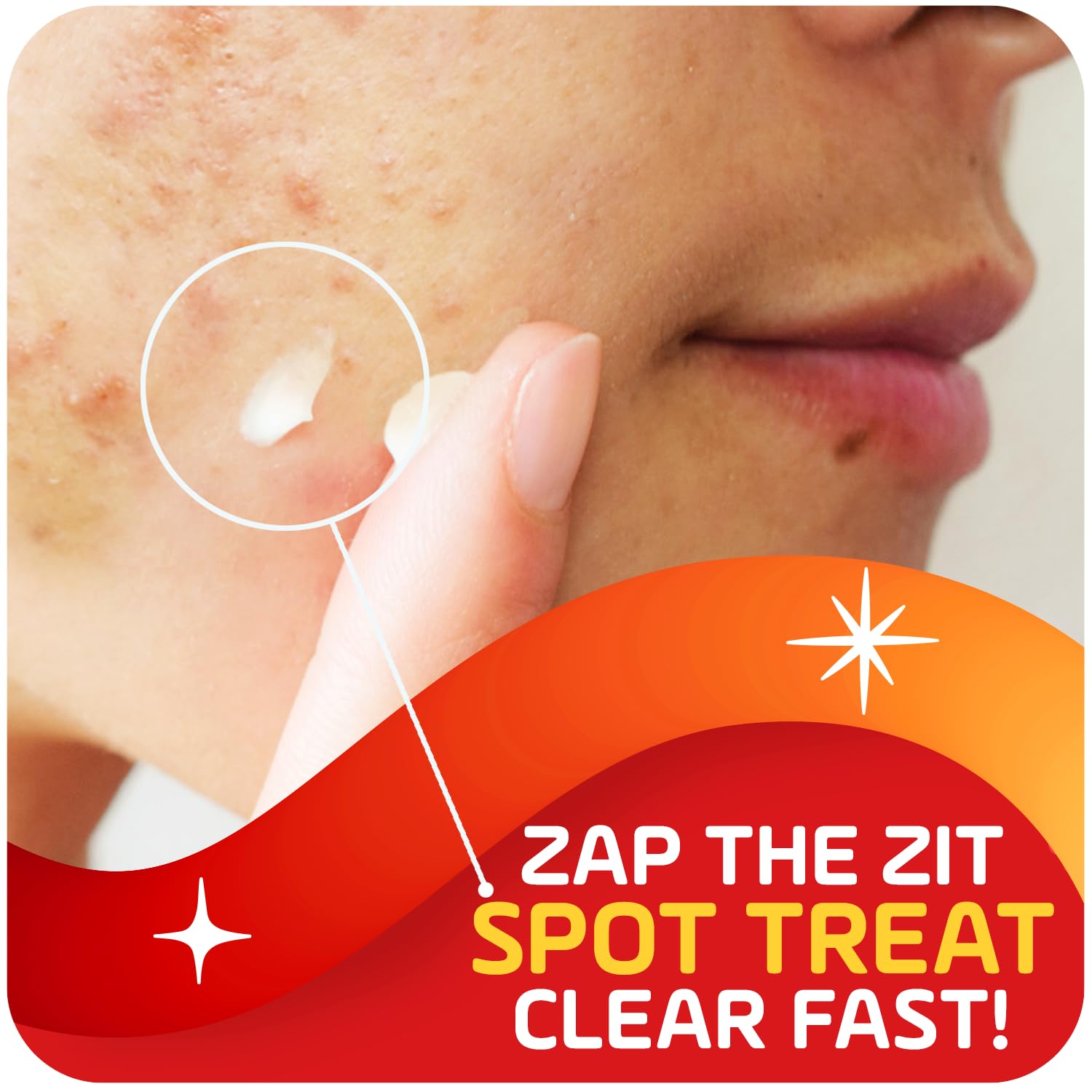 Asepxia acne spot treatment cream tube showcasing the drying formula benefits for oily skin.