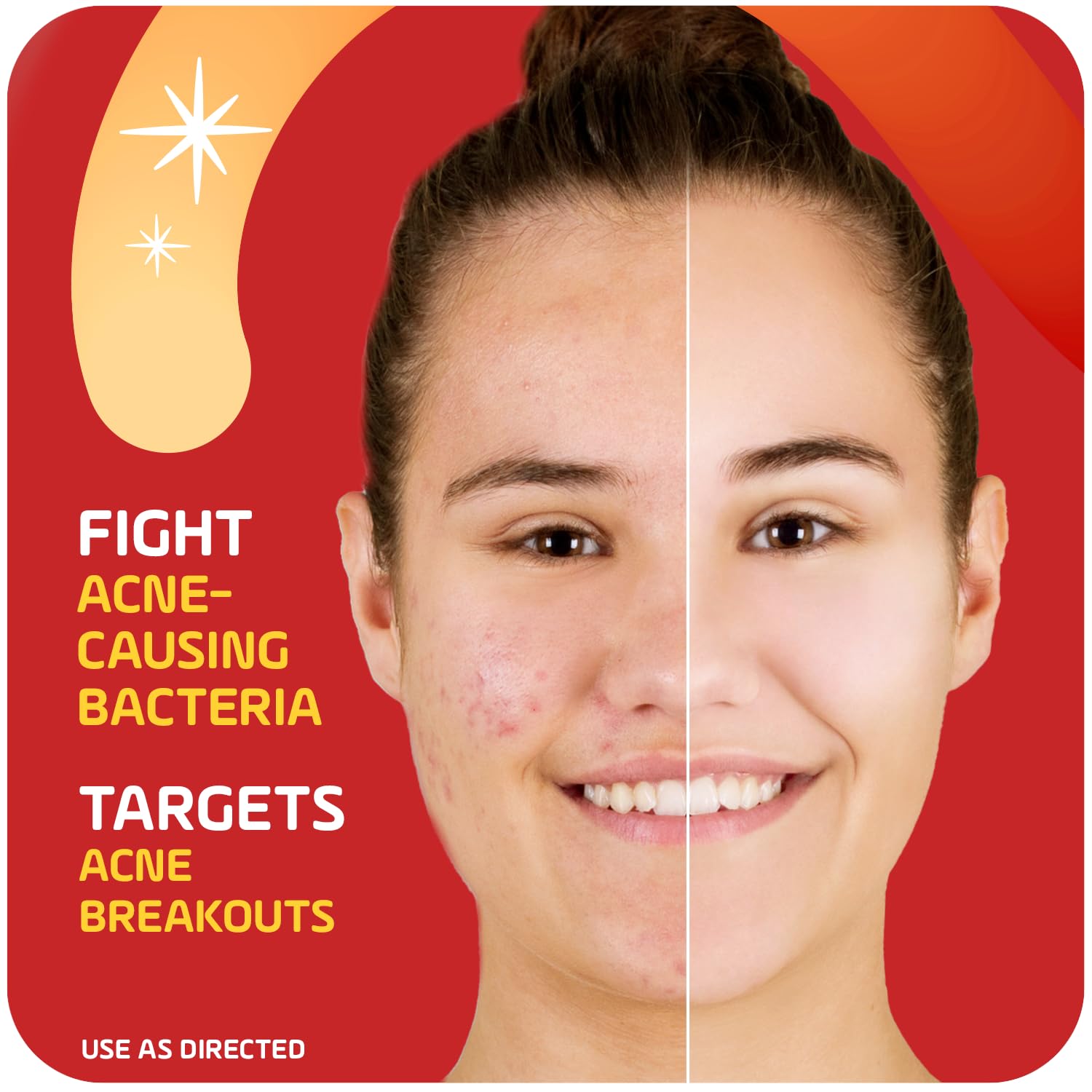 Asepxia 2 percent salicylic acid blemish treatment cream for reducing acne redness.