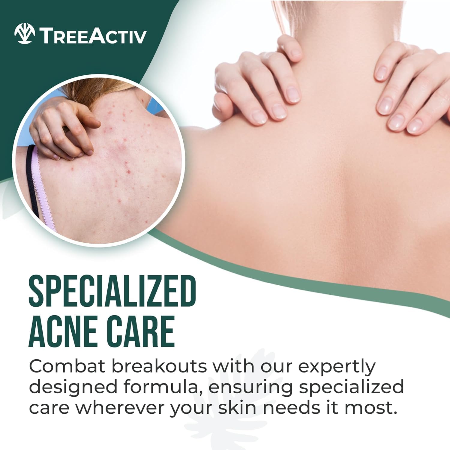 TreeActiv back acne solution mist being sprayed onto the shoulders to clear skin blemishes.