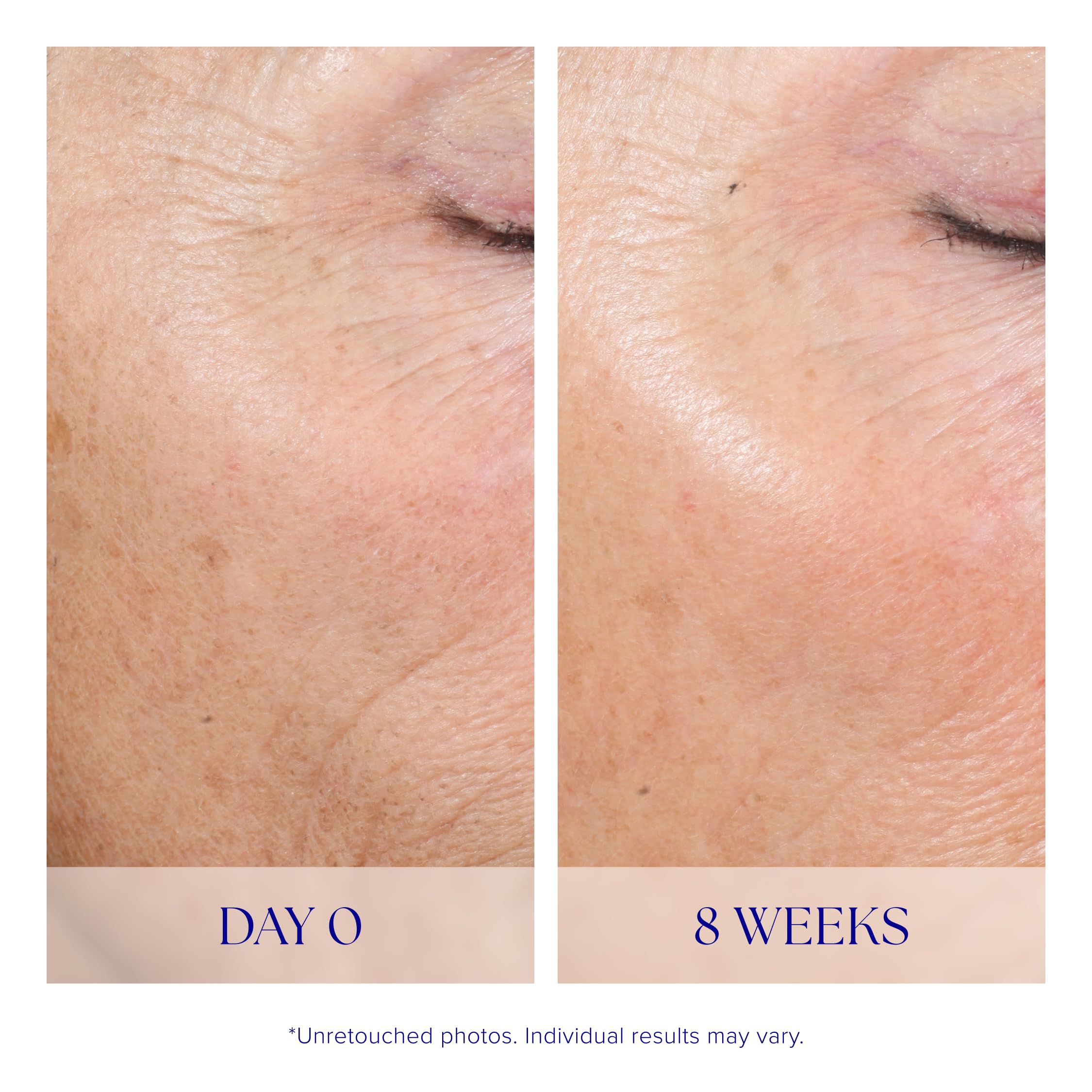 iS CLINICAL Active Peel System 15 treatment kits set arrangement